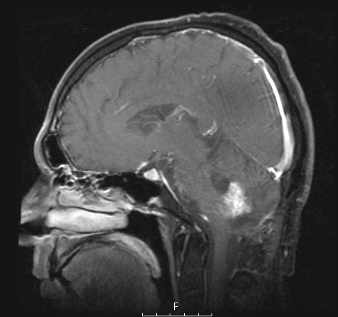 9A2 Subependymoma (Case 9) T1 Post-GAD (2) - Copy