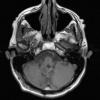 9A3 Subependymoma (Case 9) T1 Pre-GAD - Copy