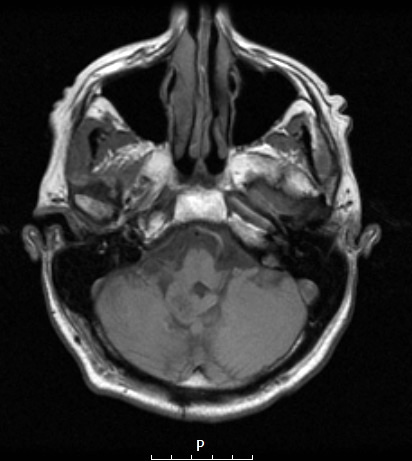 9A3 Subependymoma (Case 9) T1 Pre-GAD - Copy