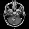 9A4 Subependymoma (Case 9) T1 Post-GAD - Copy