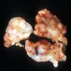 9B1 Subependymoma (Case 9) gross 2