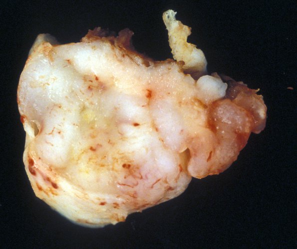 9B2 Subependymoma (Case 9) gross 1