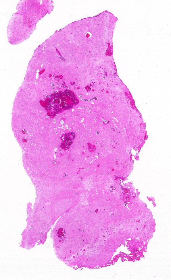 9C1 Subependymoma (Case 9) B5 H&E WM