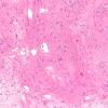 9C2 Subependymoma (Case 9) B5 H&E 10X