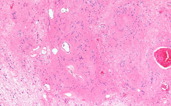 9C2 Subependymoma (Case 9) B5 H&E 10X