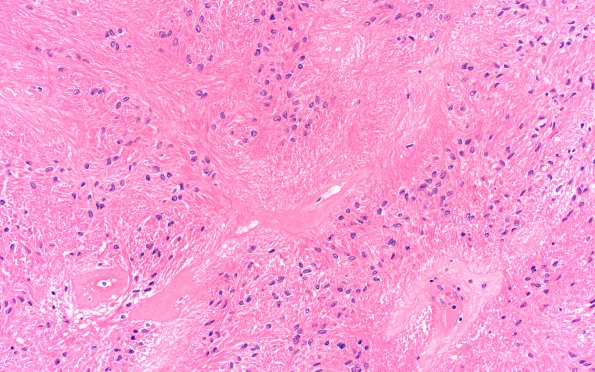 9C3 Subependymoma (Case 9) B5 H&E 20X