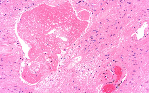 9C4 Subependymoma (Case 9) B5 H&E 20X 2