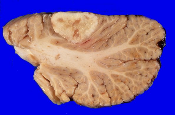 10 Metastases (Case 10) 2