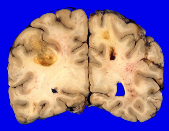 11 Metastases, breast, SP Radiation Rx (Case 11) 3