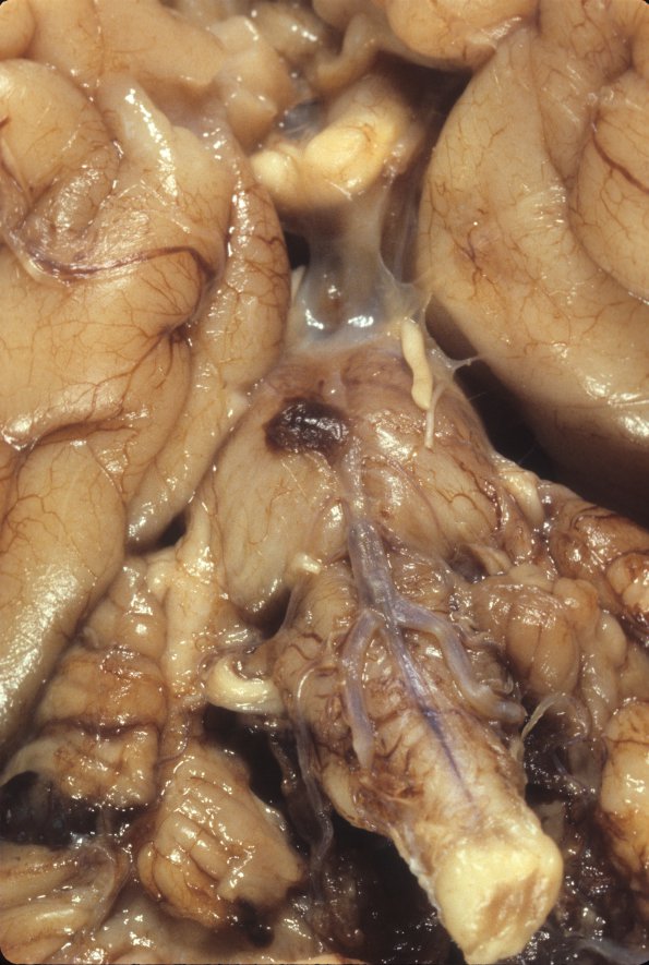 12A1 Metastases, neuroblastoma (Case 12) 1