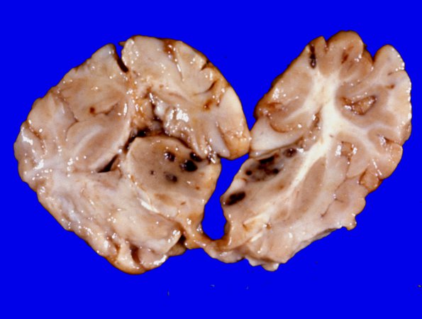 12A3 Metastases, neuroblastoma (Case 12) 3