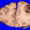 13A1 Metastasis, lung-larynx (Case 13) 1