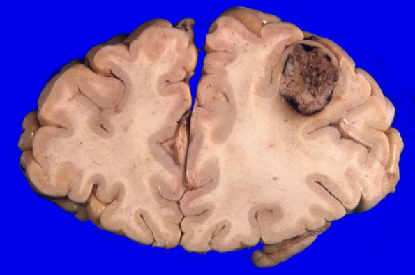 13A1 Metastasis, lung-larynx (Case 13) 1