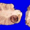 13A2 Metastasis, lung-larynx (Case 13) 2