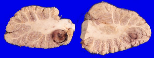 13A2 Metastasis, lung-larynx (Case 13) 2