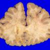 14A1 Metastases, lung (Case 14) 3