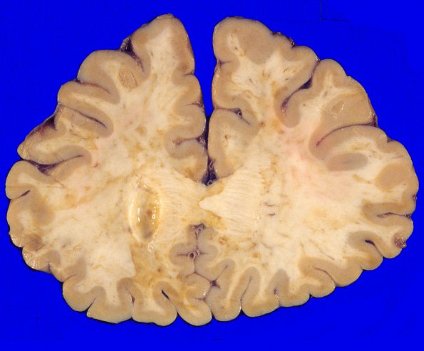 14A1 Metastases, lung (Case 14) 3