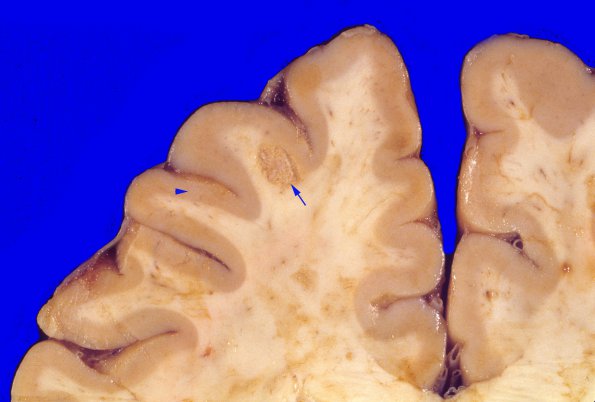 14A2 Metastases, lung (Case 14) 2 copy