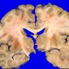 14A3 Metastases, lung (Case 14) 5