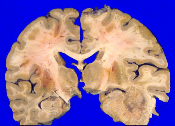 14A3 Metastases, lung (Case 14) 5