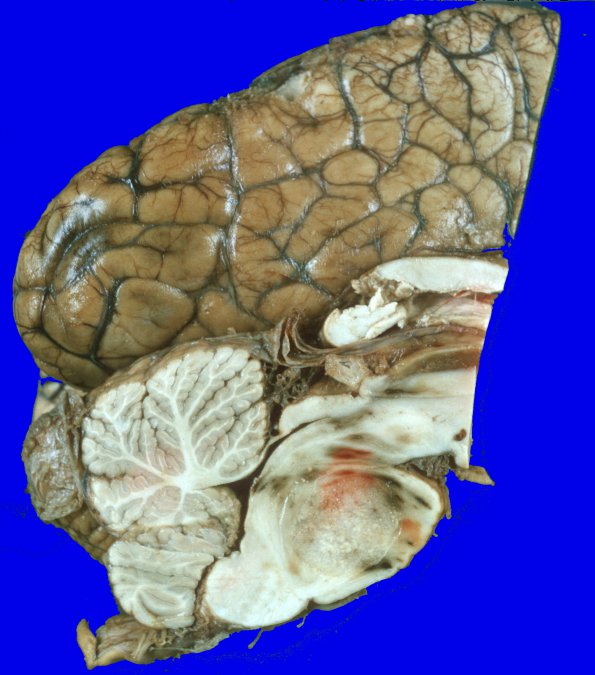 15 Metastasis, breast (Case 15) Gross 1