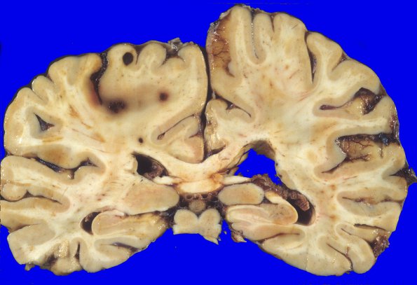 16A2 Metastasis, breast (Case 16) 3