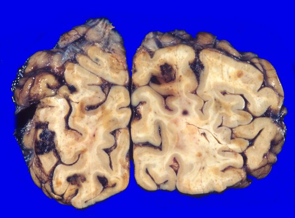 16A3 Metastasis, breast (Case 16) 2