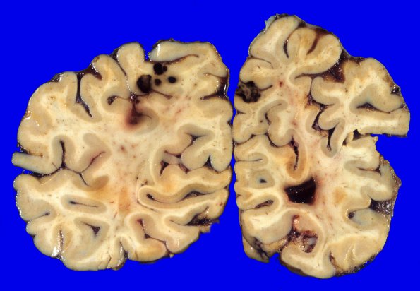 16A4 Metastasis, breast (Case 16) 6