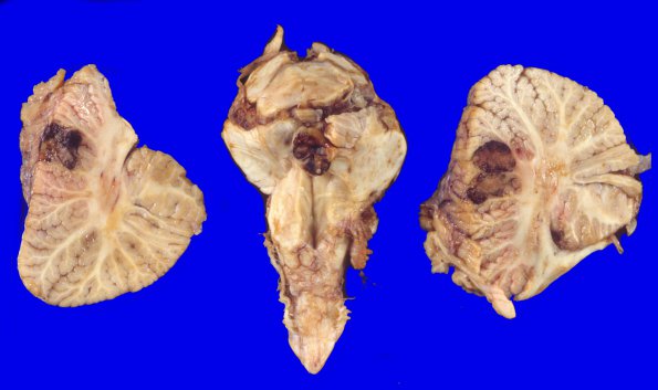 16A5 Metastasis, breast (Case 16) 4