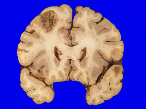 17A2 Metastasis, lung (Case 17) gross_3