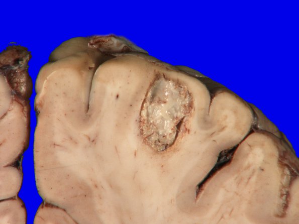 17A5 Metastasis, lung (Case 17) gross_8