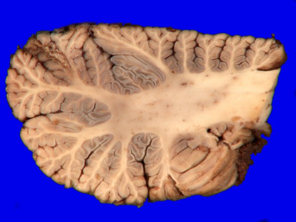 17A7 Metastasis, lung (Case 17) gross_10