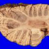 17A8 Metastasis, lung (Case 17) gross_12