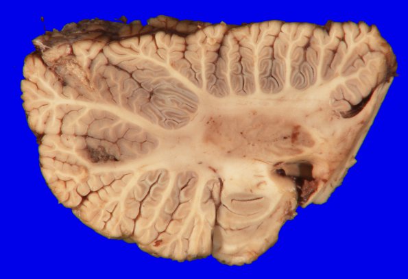 17A8 Metastasis, lung (Case 17) gross_12