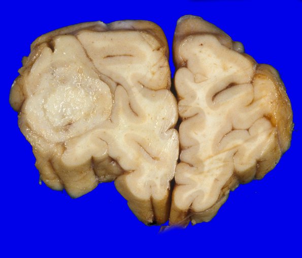 18A1 Metastasis, lung (Case 18) 5