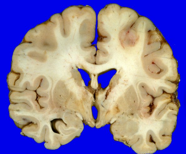 18A2 Metastasis, lung (Case 18) 3