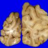 18A5 Metastasis, lung (Case 18) 4