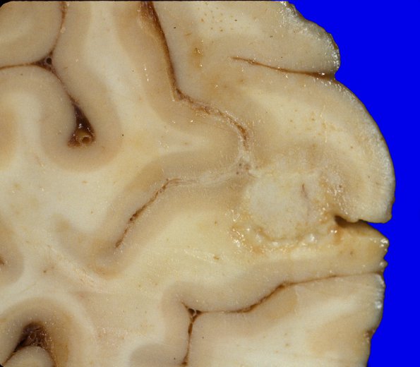 18A6 Metastasis, lung (Case 18) 6