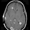 1A1 Metastasis, Small Cell Neuroendocrine (Case 1) T1 W 2