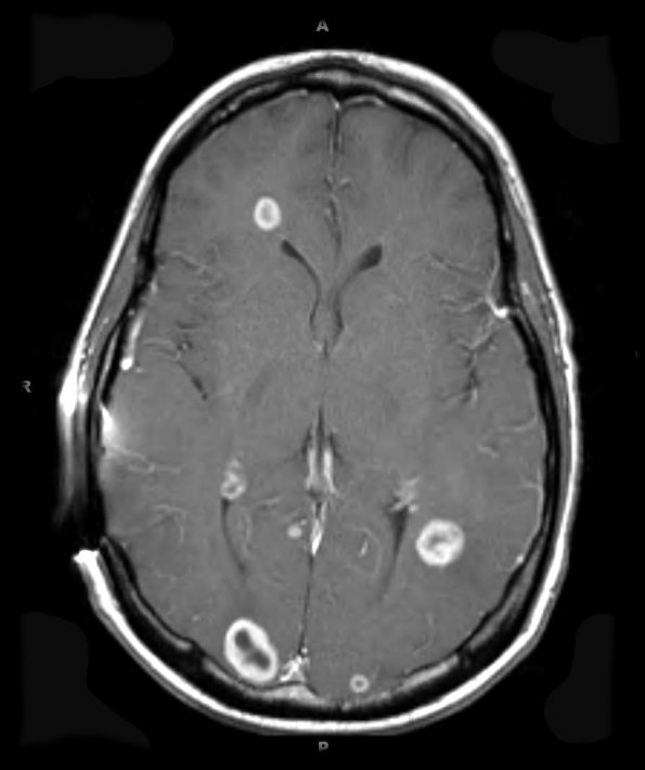 1A1 Metastasis, Small Cell Neuroendocrine (Case 1) T1 W 2