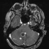 1A2 Metastasis, Small Cell Neuroendocrine (Case 1) T1 W 8