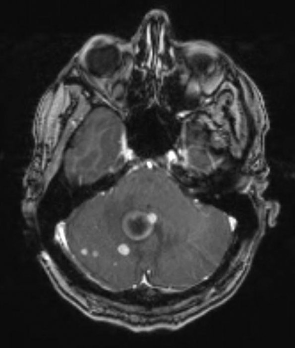 1A2 Metastasis, Small Cell Neuroendocrine (Case 1) T1 W 8