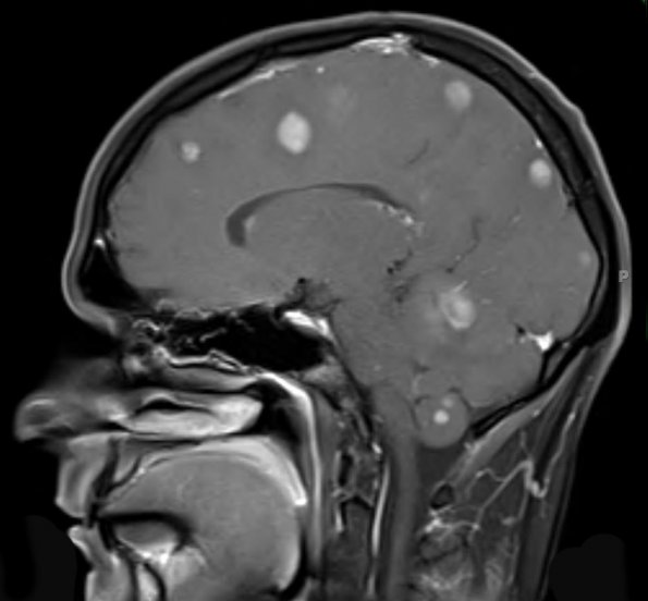 1A3 Metastasis, Small Cell Neuroendocrine (Case 1) T1 W 11