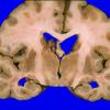 20A1 Metastasis, lung, intraventricular (Case 20) 2