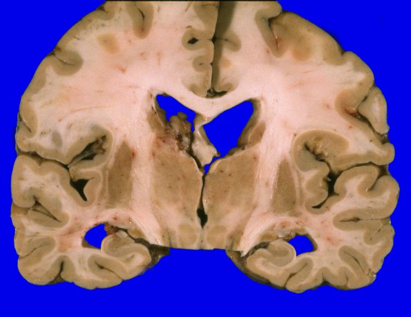 20A1 Metastasis, lung, intraventricular (Case 20) 2