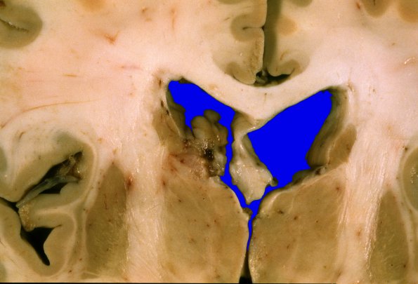 20A2 Metastasis, lung, intraventricular (Case 20) 1