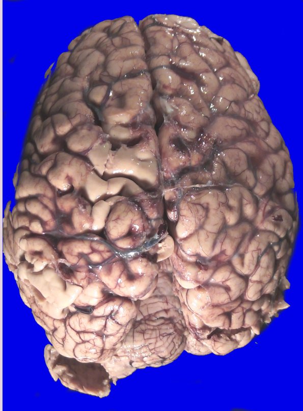 22A4 Metastases (Case 22) Gross _1