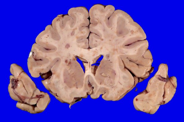 22D2 Metastases (Case 22) Gross _12