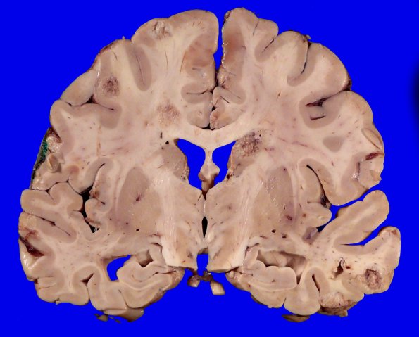 22F2 Metastases (Case 22) Gross _11