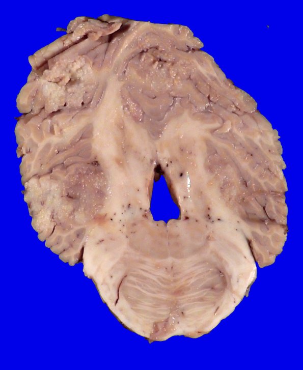 22H5 Metastases (Case 22) Gross _5